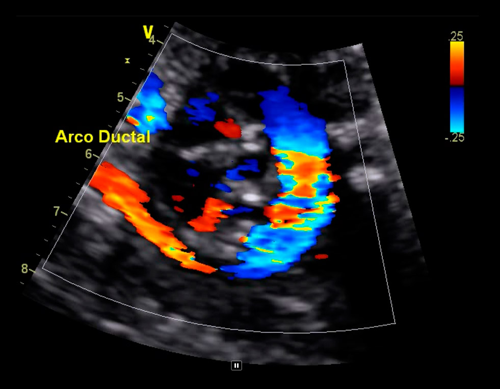 Demonstrativos Ecocardiograma Fetal - Clínica Oftcor